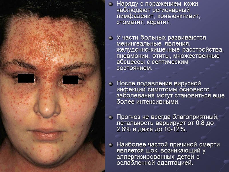 Наряду с поражением кожи наблюдают регионарный лимфаденит, конъюнктивит, стоматит, кератит.   У части